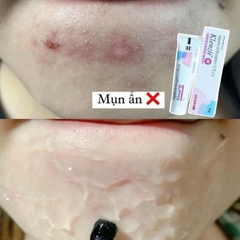 [Ấn Độ]Gel Trị Mụn Klenzit MS Aqueous Gel Mụn Ẩn, Mụn Viêm, Mụn Đầu Đen 15g