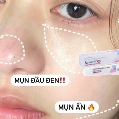 [Ấn Độ]Gel Trị Mụn Klenzit MS Aqueous Gel Mụn Ẩn, Mụn Viêm, Mụn Đầu Đen 15g
