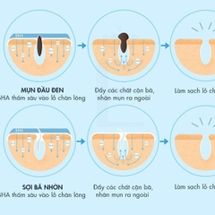 Tẩy Da Chết Hóa Học Obagi Clenziderm MD Pore Therapy BHA 2%