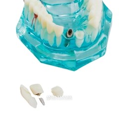 Hàm tư vấn bệnh lý, cầu răng, implant trong nha khoa - Hàm tư vấn 5 in 1