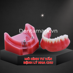 Hàm tư vấn tháo lắp 2 Implant - Mẫu hàm tháo lắp trên Implant