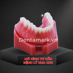 Hàm tư vấn tháo lắp 2 Implant - Mẫu hàm tháo lắp trên Implant