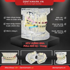 Hàm tư vấn chỉnh nha full khí cụ - Răng khấp khểnh