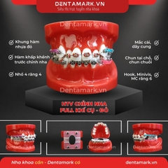 Hàm tư vấn chỉnh nha full khí cụ - Răng khấp khểnh