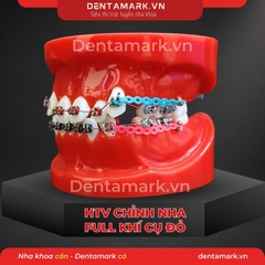 Hàm tư vấn chỉnh nha full khí cụ - Răng khấp khểnh