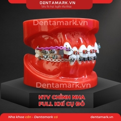 Hàm tư vấn chỉnh nha full khí cụ - Răng khấp khểnh