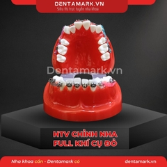 Hàm tư vấn chỉnh nha full khí cụ - Răng khấp khểnh
