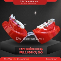 Hàm tư vấn chỉnh nha full khí cụ - Răng khấp khểnh