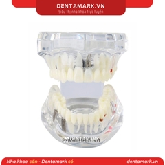 Hàm tư vấn bệnh lý, cầu răng, implant trong nha khoa - Hàm tư vấn 5 in 1