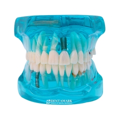 Hàm tư vấn bệnh lý, cầu răng, implant trong nha khoa - Hàm tư vấn 5 in 1