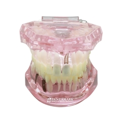 Hàm tư vấn bệnh lý, cầu răng, implant trong nha khoa - Hàm tư vấn 5 in 1