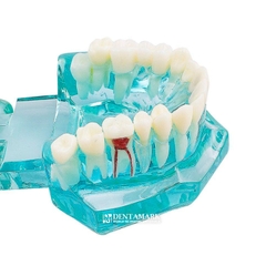 Hàm tư vấn bệnh lý, cầu răng, implant trong nha khoa - Hàm tư vấn 5 in 1