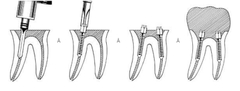 Chốt kim loại vàng Dental Nordin - Hộp 120 cái