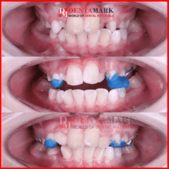 Composite gắn band nâng khớp Ultra Ortho Band IL-Chung - Tuýp 5g