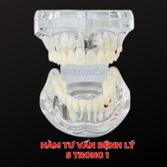Hàm tư vấn bệnh lý, cầu răng, implant trong nha khoa - Hàm tư vấn 5 in 1