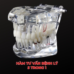 Hàm tư vấn bệnh lý, cầu răng, implant trong nha khoa - Hàm tư vấn 5 in 1