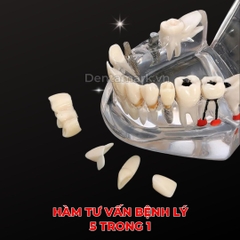 Hàm tư vấn bệnh lý, cầu răng, implant trong nha khoa - Hàm tư vấn 5 in 1