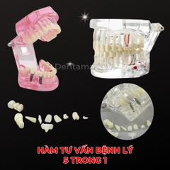 Hàm tư vấn bệnh lý, cầu răng, implant trong nha khoa - Hàm tư vấn 5 in 1