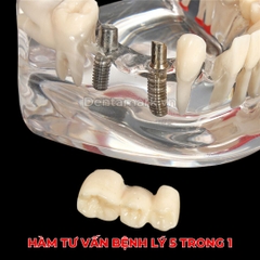 Hàm tư vấn bệnh lý, cầu răng, implant trong nha khoa - Hàm tư vấn 5 in 1