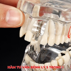 Hàm tư vấn bệnh lý, cầu răng, implant trong nha khoa - Hàm tư vấn 5 in 1