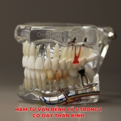 Hàm tư vấn bệnh lý, cầu răng, implant trong nha khoa - Hàm tư vấn 5 in 1 có dây thần kinh