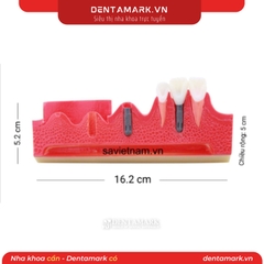 Hàm tư vấn các bước cắm Implant