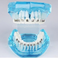 Hàm tư vấn chỉnh nha mắc cài kim loại