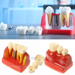 Hàm tư vấn so sánh implant và cầu răng