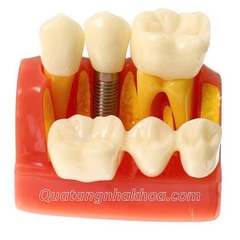 Hàm tư vấn so sánh implant và cầu răng