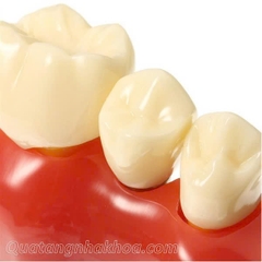 Hàm tư vấn so sánh implant và cầu răng