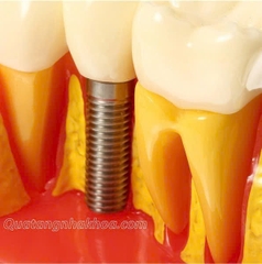Hàm tư vấn so sánh implant và cầu răng