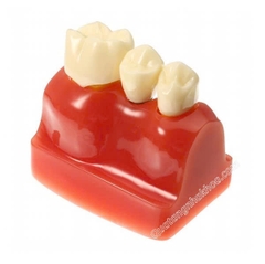 Hàm tư vấn so sánh implant và cầu răng
