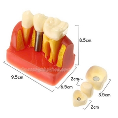 Hàm tư vấn so sánh implant và cầu răng