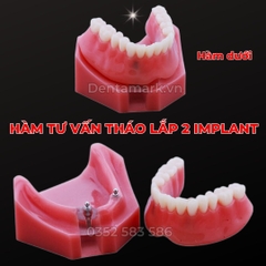 Hàm tư vấn tháo lắp 2 Implant - Mẫu hàm tháo lắp trên Implant