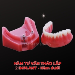 Hàm tư vấn tháo lắp 2 Implant - Mẫu hàm tháo lắp trên Implant