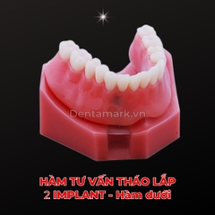Hàm tư vấn tháo lắp 2 Implant - Mẫu hàm tháo lắp trên Implant