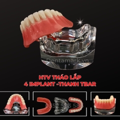 Hàm tư vấn tháo lắp 4 Implant - Mẫu hàm tháo lắp trên Implant (Implant All On 4)