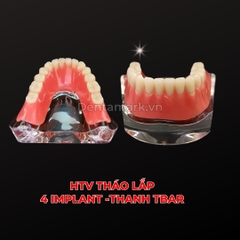 Hàm tư vấn tháo lắp 4 Implant - Mẫu hàm tháo lắp trên Implant (Implant All On 4)