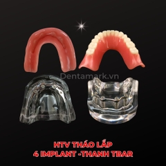 Hàm tư vấn tháo lắp 4 Implant - Mẫu hàm tháo lắp trên Implant (Implant All On 4)