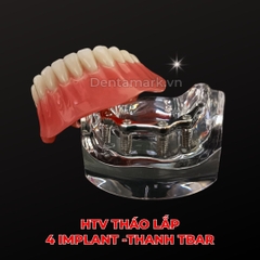 Hàm tư vấn tháo lắp 4 Implant - Mẫu hàm tháo lắp trên Implant (Implant All On 4)
