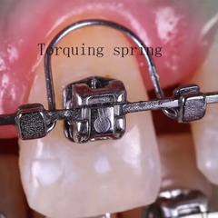 Lò xo WARREN TORQUE 1 răng dạng bấm dùng cho tất cả các cỡ dây (Gói 10 chiếc)