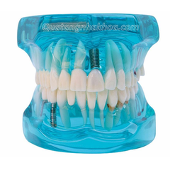 Hàm tư vấn bệnh lý, cầu răng, implant trong nha khoa - Hàm tư vấn 5 in 1 có dây thần kinh