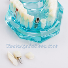 Hàm tư vấn bệnh lý, cầu răng, implant trong nha khoa - Hàm tư vấn 5 in 1 có dây thần kinh