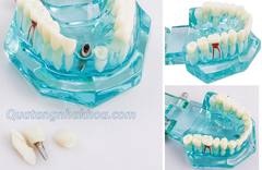 Hàm tư vấn bệnh lý, cầu răng, implant trong nha khoa - Hàm tư vấn 5 in 1 có dây thần kinh