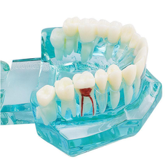 Hàm tư vấn bệnh lý, cầu răng, implant trong nha khoa - Hàm tư vấn 5 in 1 có dây thần kinh