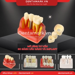 Hàm tư vấn so sánh implant và cầu răng