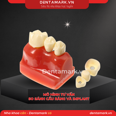 Hàm tư vấn so sánh implant và cầu răng