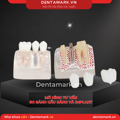 Hàm tư vấn so sánh implant và cầu răng