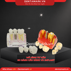 Hàm tư vấn so sánh implant và cầu răng