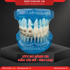 Hàm tư vấn chỉnh nha so sánh chỉnh nha mắc cài Kim loại - mắc cài sứ